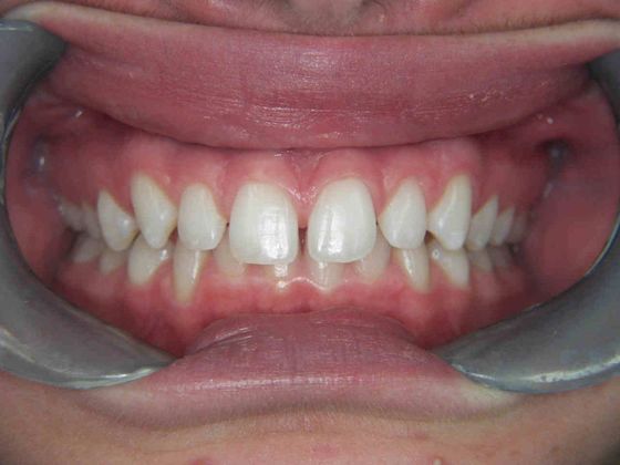 Before Invisalign